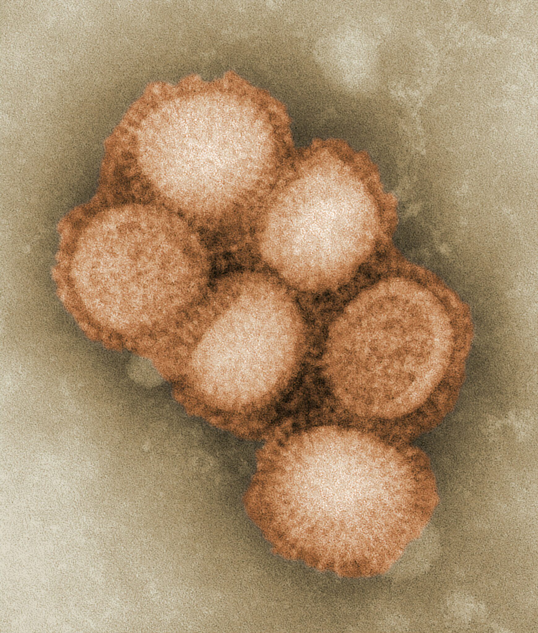 Rare human case of swine flu is detected in Spain: What to know after ...